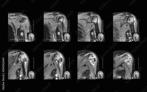 Magnetic Resonance Imaging Mri Scan Of Shoulder Joint Pain Coronal