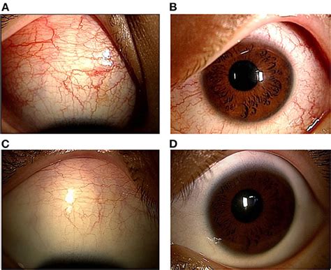 Frontiers Case Report Anterior Scleritis Presenting As A Primary