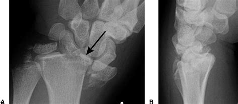 Transstyloid Translunate Fracturedislocation Of The Wrist Case