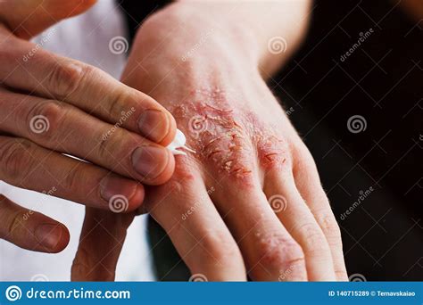 Eczema Sulle Mani Luomo Che Applica Lunguento Screma Nel Trattamento