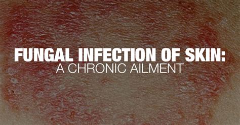 What Are Fungal Infections Of The Skin Know The Facts
