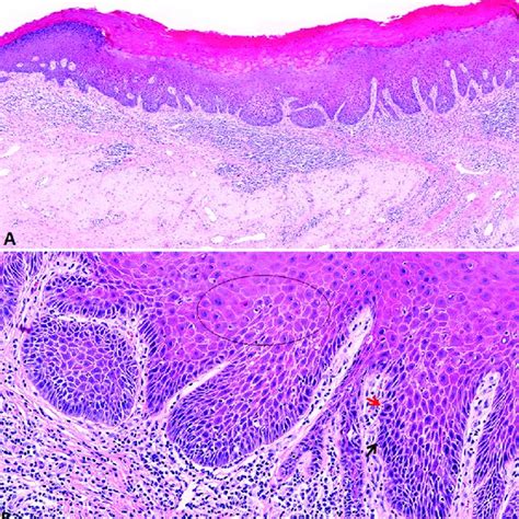 Differentiated Vulvar Intraepithelial Neoplasia Dvin Histology And