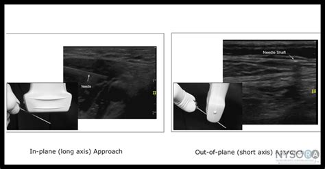 Optimizing An Ultrasound Image Nysora The New York School Of Regional