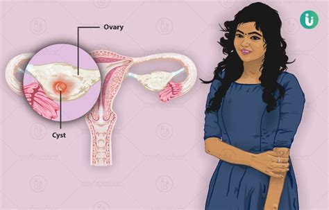 Ovarian Cysts Symptoms Causes Treatment Medicine Prevention Diagnosis
