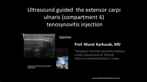 Ultrasound Guided The Extensor Carpi Ulnaris Compartment 6