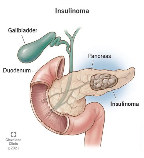 Insulinoma Definition Symptoms Diagnosis Treatment Novel Men Gene Findings In Rare