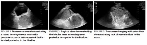 Intraabdominal Abscess Identified By Point Of Care Ultrasound In A
