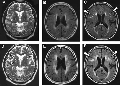 Example Of Small Vessel Disease Progression On Brain Mri Figures Show
