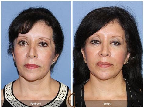 Facial Fat Grafting Before And After Photos From Dr Kevin Sadati