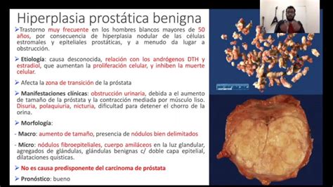 Anatom A Patol Gica Hiperplasia Prost Tica Benigna Y Adenocarcinoma