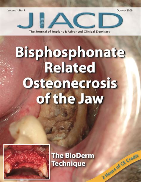 Bisphosphonate Related Osteonecrosis Of The Jaw — Jiacd Jiacd