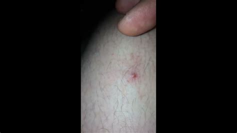 Pimple Popping On Leg Gross Youtube