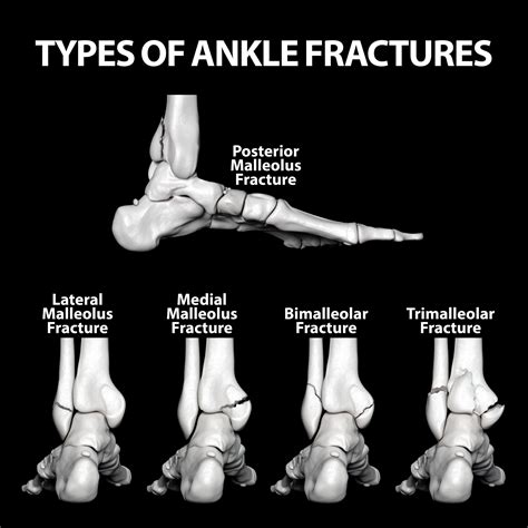 Ankle Fracture Surgery Florida Orthopaedic Institute