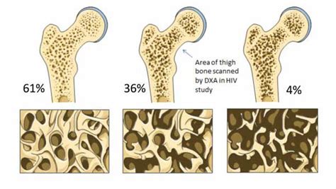 What You Need To Know About Osteoporosis Canes Community Care