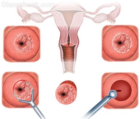 Excessive or prolonged menstrual bleeding can lead to other medical conditions, including: Stenosis: Spotting And Cramping With Mirena