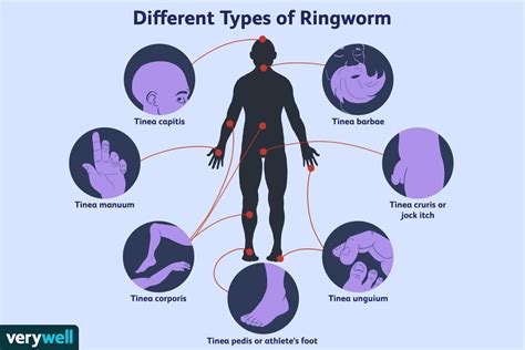 Ringworm Overview And More