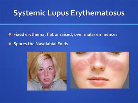 Ppt Cutaneous Manifestations Of Systemic Diseases Powerpoint
