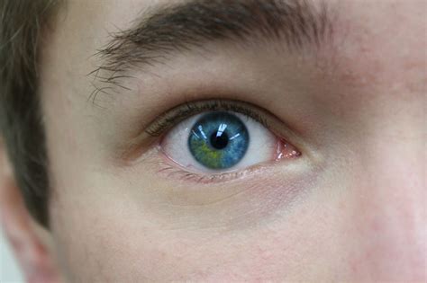 Sectoral Heterochromia Blue Green 2 Colored Eyes Waardenburg The