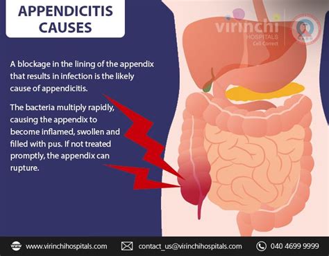 Appendicitis Causes Digestive Health Gastroenterology Health