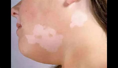 Want To Get Rid Of White Spots On Face Try These Effective Remedies