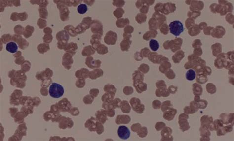 Medium Power Field Of Peripheral Blood Smear Showing Rouleaux Download Scientific Diagram