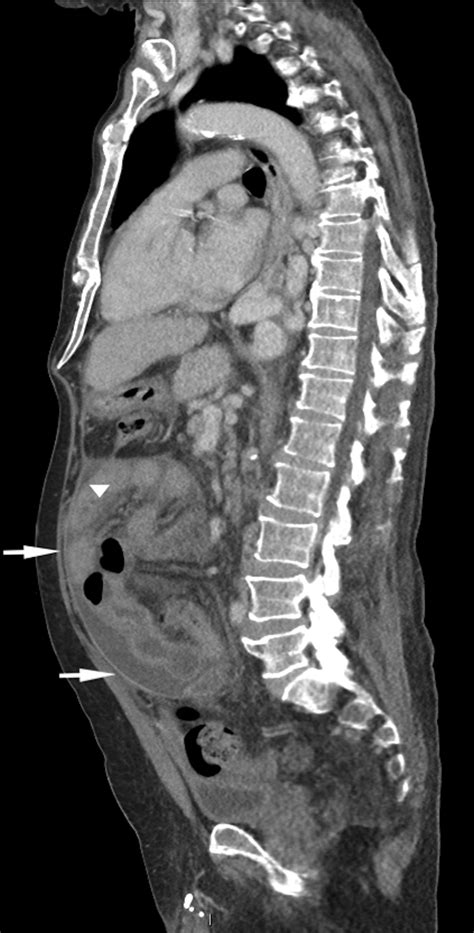 Male With Diffuse Abdominal Pain Annals Of Emergency Medicine