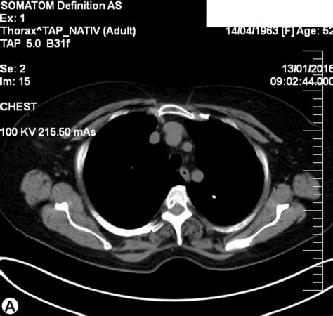 A And B Ct Scan Small Calcified Nodule In Left Upper Lobe Enlarged