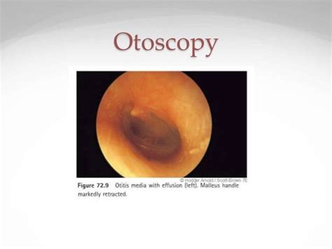 Ome Otitis Media With Effusion In Children