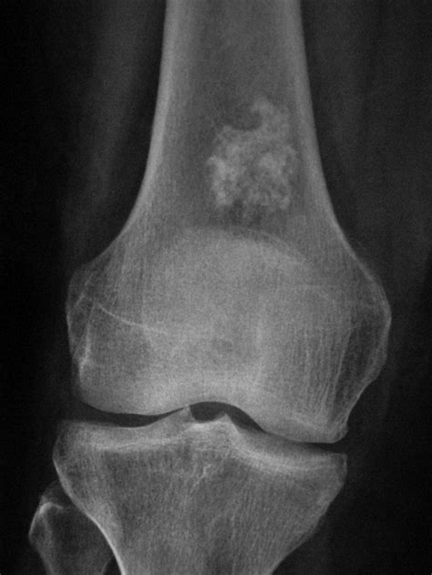 An Enchondroma Incidentally Noticed In The Distal Femur Radiograph Of A