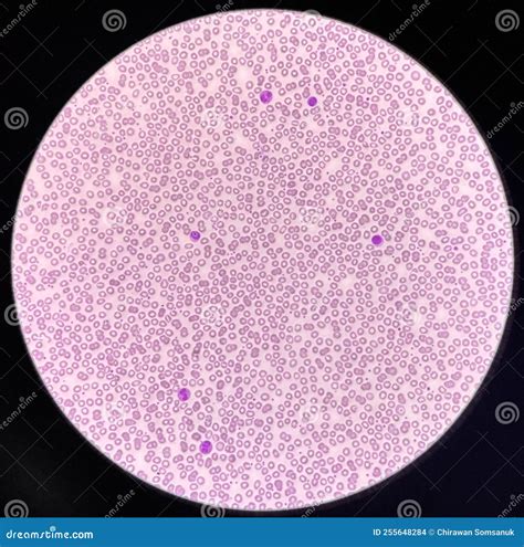 Normochromic And Normocytic Rbc Blood Smear Stock Photo Image Of