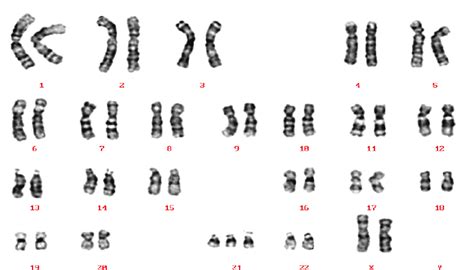 A Karyotype Of A Down Syndrome Patient 47 Xx21 Reproduced Download Scientific Diagram