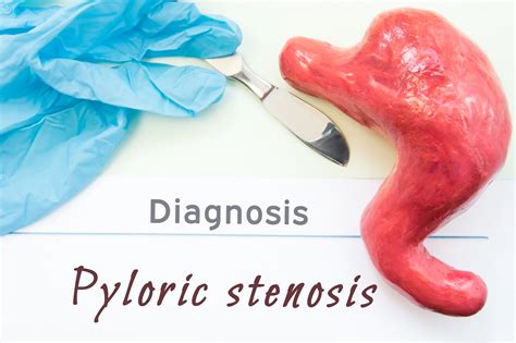 Pyloric Stenosis In Babies A Diagnosis Thats Not Hard To Swallow