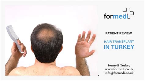 Hair Transplant In Turkey Patient Review Youtube