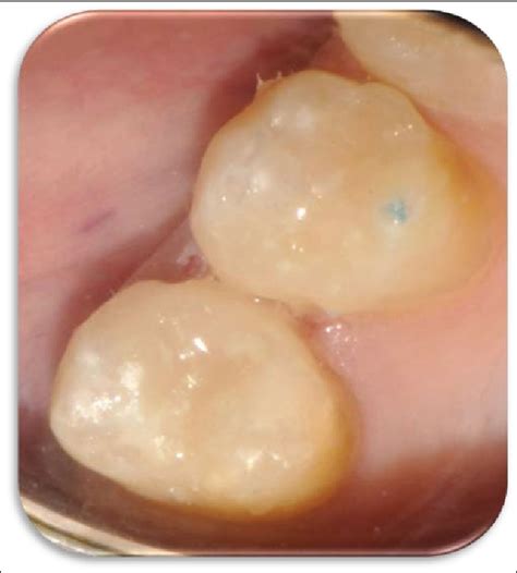 Stepwise Excavation A Conservative Community Based Dental Treatment Of