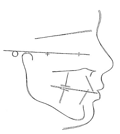 Computer Generated Facial Measurements For Orthodontics Telegraph