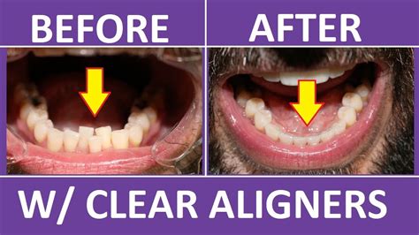Invisalign Braces Before And After Overbite Crowding Teeth Cost Pain Tips 3m Clear Aligners