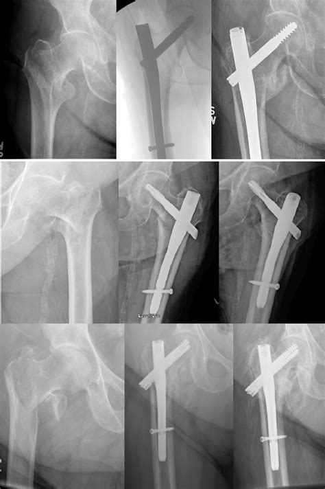 No Harm When Residents Are Involved In Hip Fracture Surgery Orthobuzz