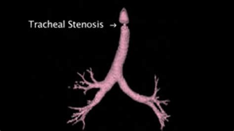 Treatment Of Tracheal Stenosis Memorial Sloan Kettering Cancer Center