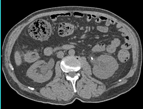 Obstructing Stone in Proximal Left Ureter - Genitourinary Case Studies - CTisus CT Scanning