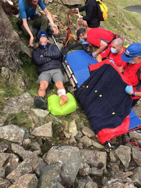 Hiker Shares Graphic Images Of Injuries After 12 Ft Fall Viral News
