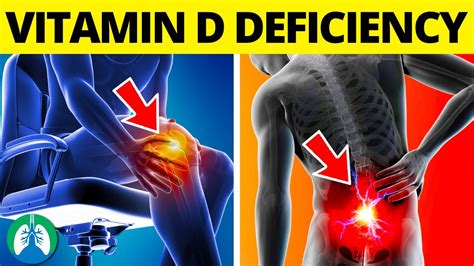 Top Signs Of Vitamin D Deficiency That You Must Know Youtube