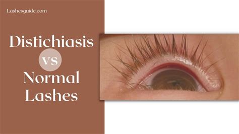 distichiasis vs normal lashes lashes guide