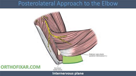 Posterolateral Approach To The Elbow 2023 Orthofixar