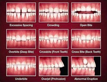 Malocclusion Difference Between Overbite Overjet And Open Bite Hot
