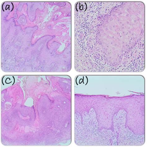 Histopathology Of Lesions Before And During Acitretin Treatment A