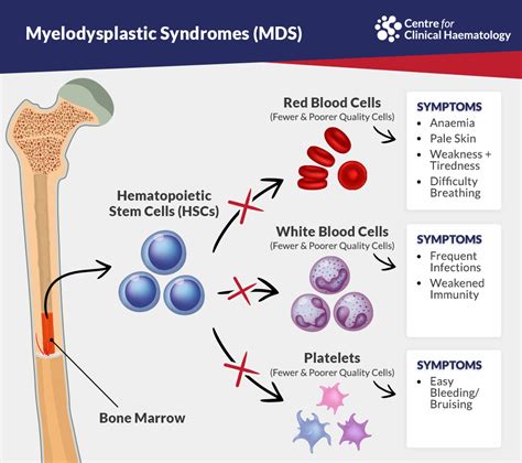 Myelodysplastic Syndromes Signs And Treatments In Singapore