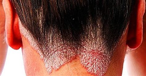 Scalp Psoriasis Symptoms And Treatment Celebrities Funda