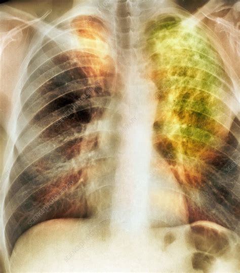 Old And New Tuberculosis X Ray Stock Image C0072669 Science