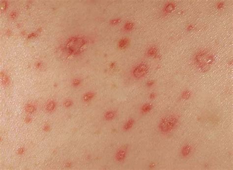 Maculopapular Rash Pictures Symptoms Causes Diagnosis Treatment