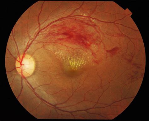 Central Retinopathy Vein Occlusion Eye Disorders And Diseases